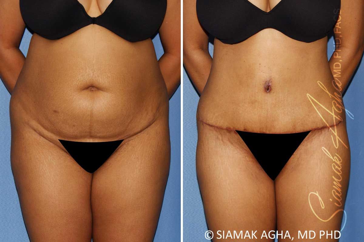 Tummy Tuck Before & After