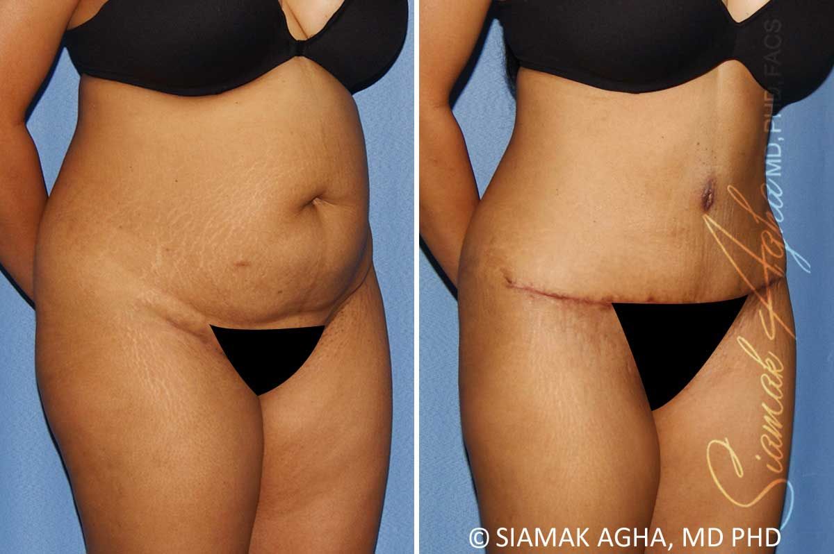 Tummy Tuck Before & After
