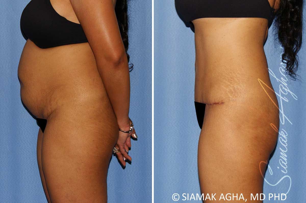 Tummy Tuck Before & After