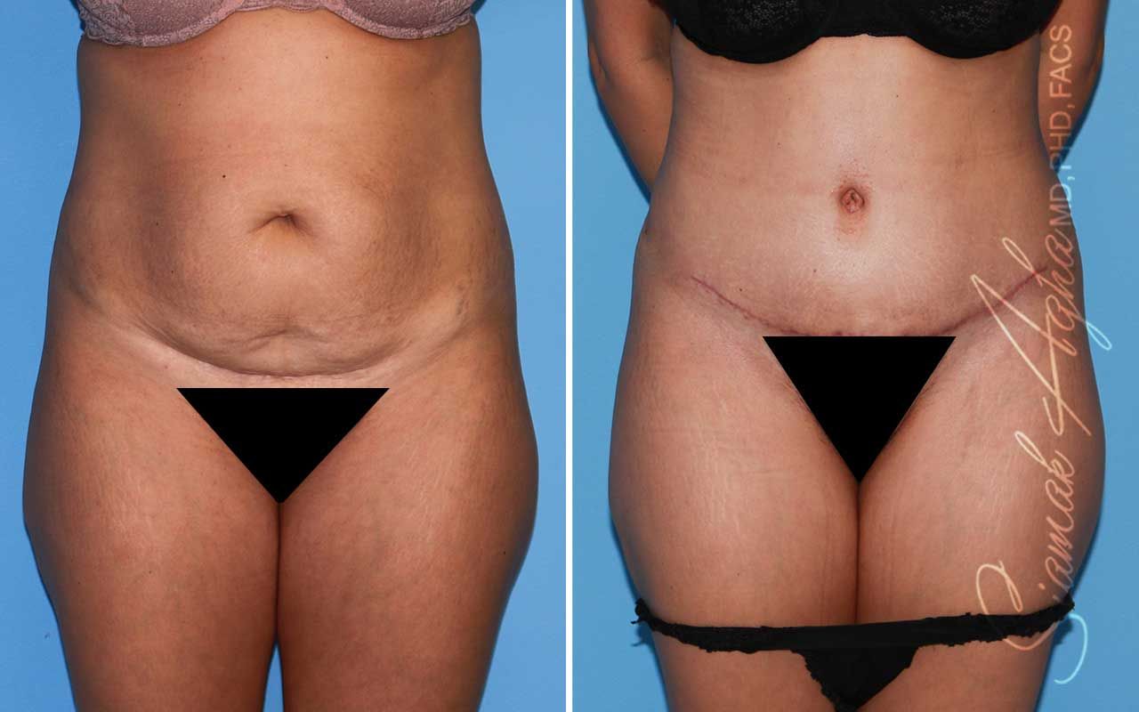 Tummy Tuck Before & After