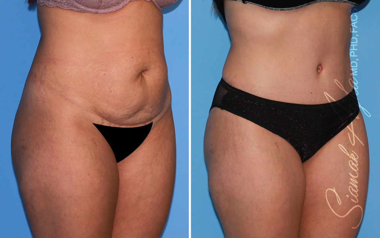 Tummy Tuck Before & After