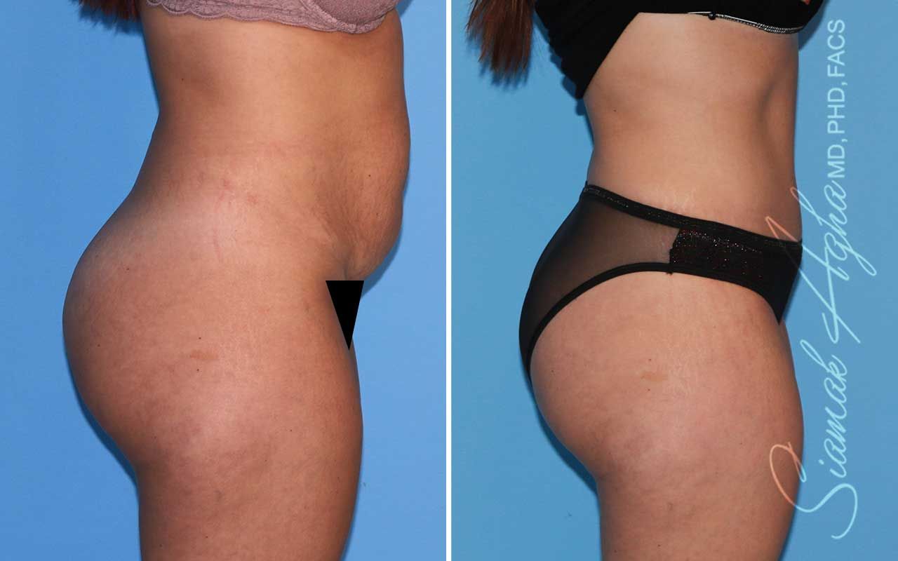 Tummy Tuck Before & After