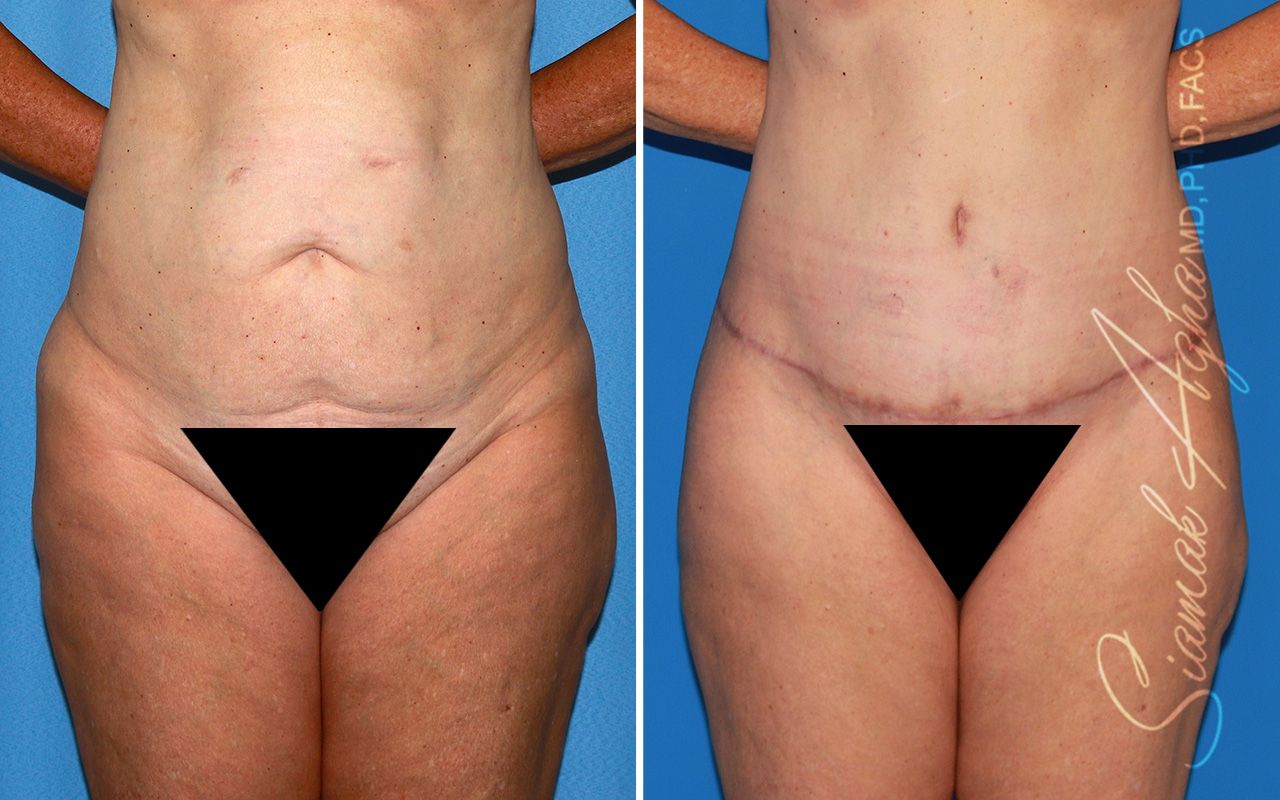 Tummy Tuck Before & After