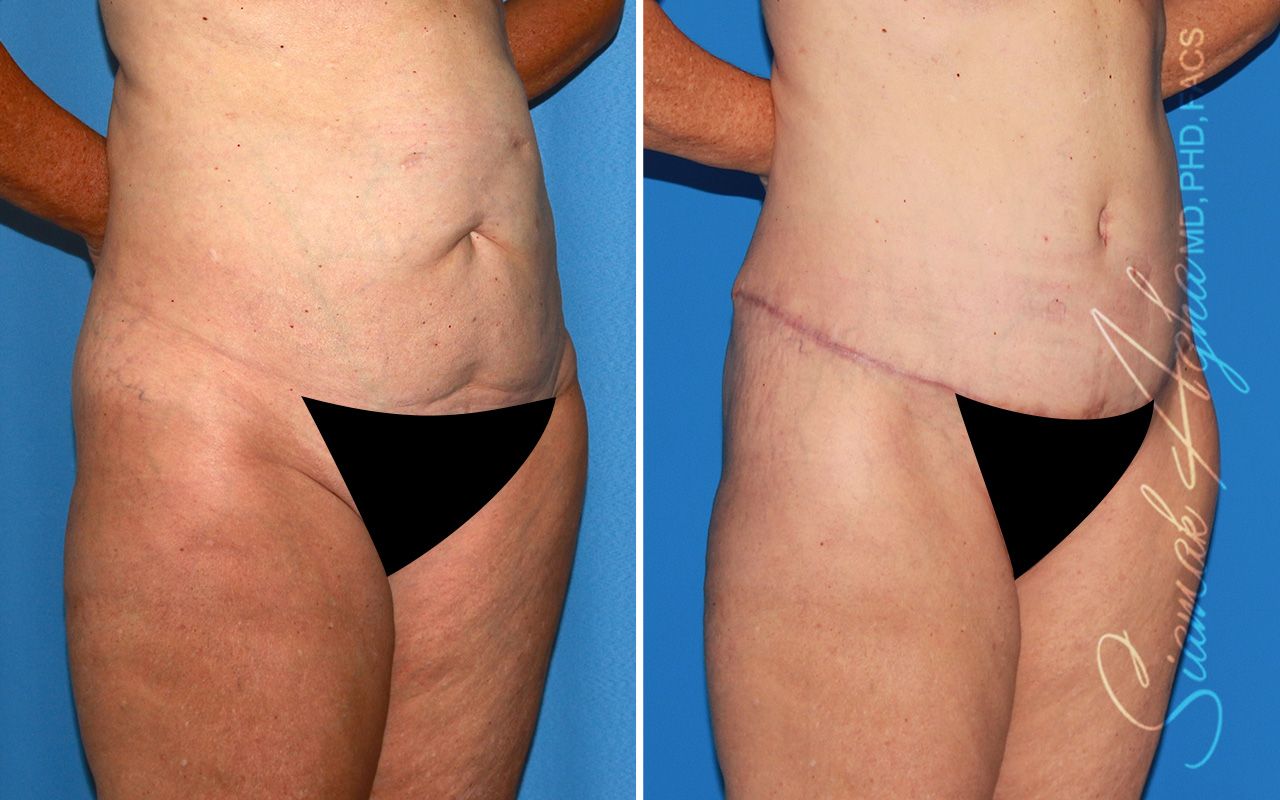 Tummy Tuck Before & After