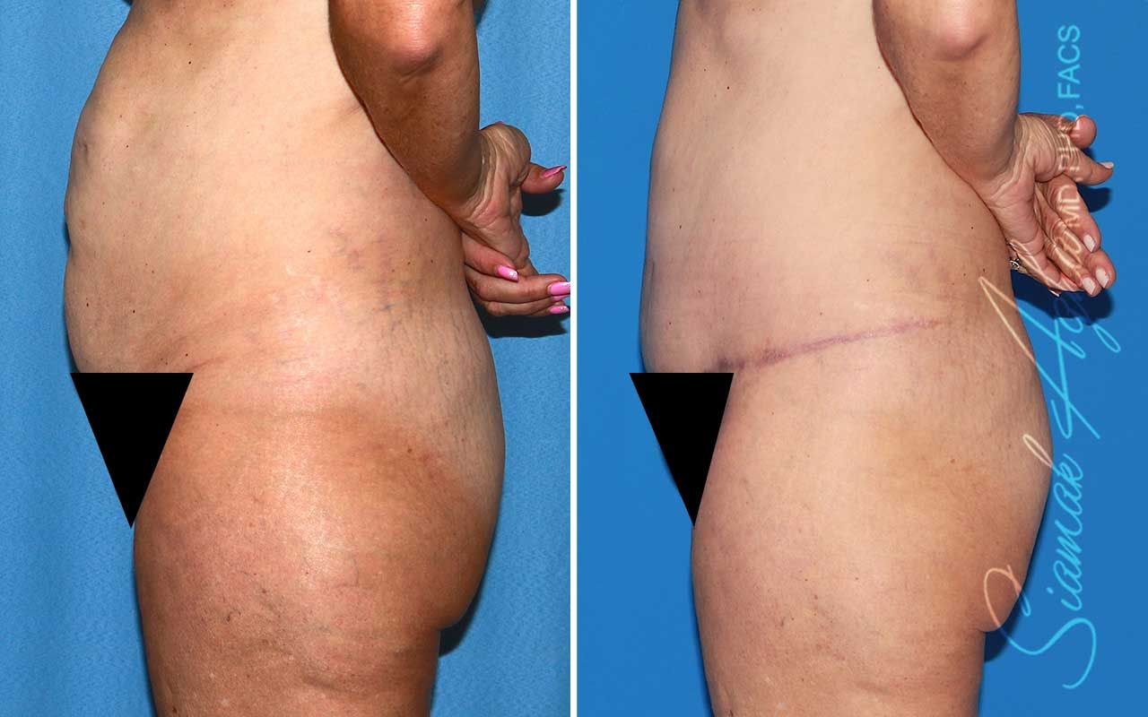 Tummy Tuck Before & After