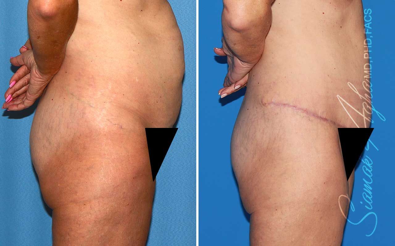 Tummy Tuck Before & After