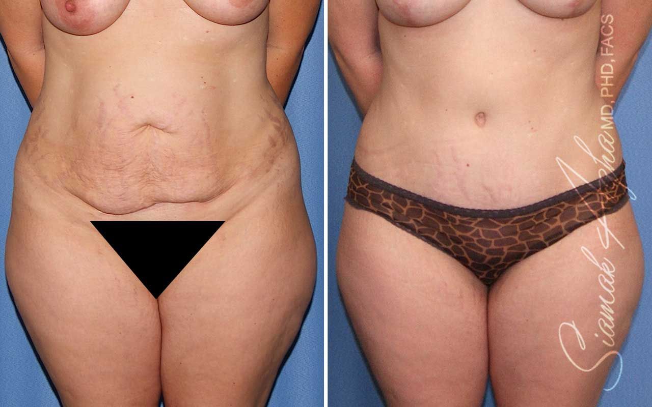 Tummy Tuck Before & After