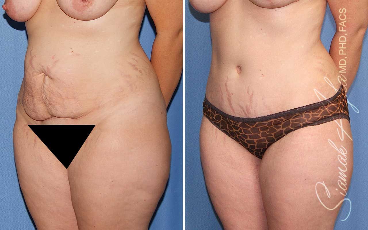 Tummy Tuck Before & After
