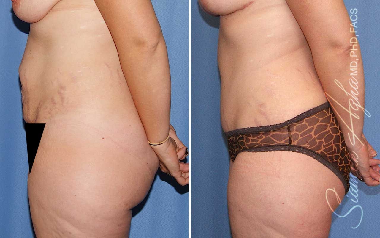 Tummy Tuck Before & After