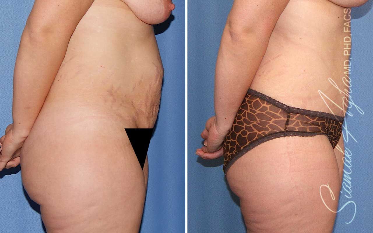 Tummy Tuck Before & After