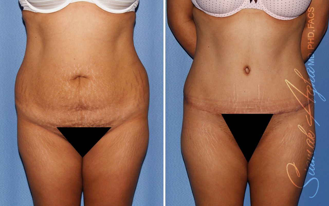 Tummy Tuck Before & After