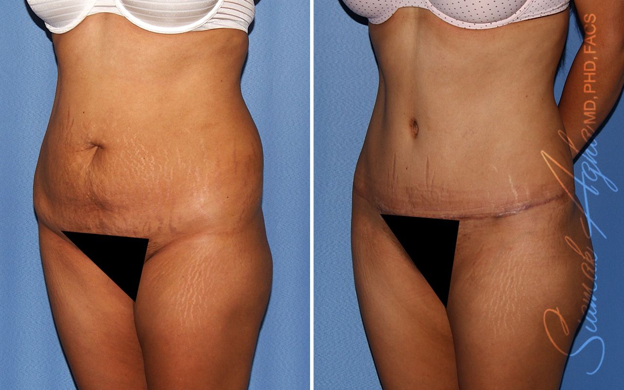 Tummy Tuck Before & After