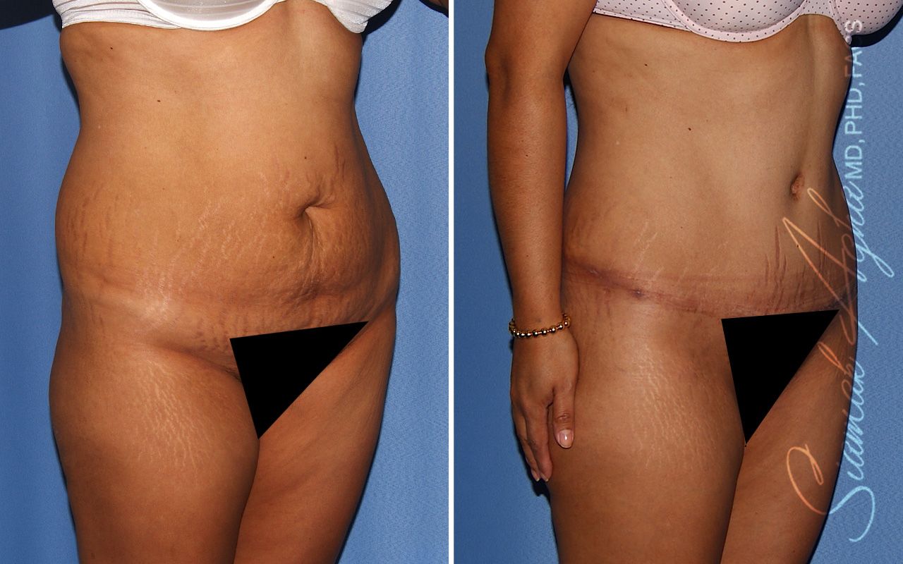 Tummy Tuck Before & After