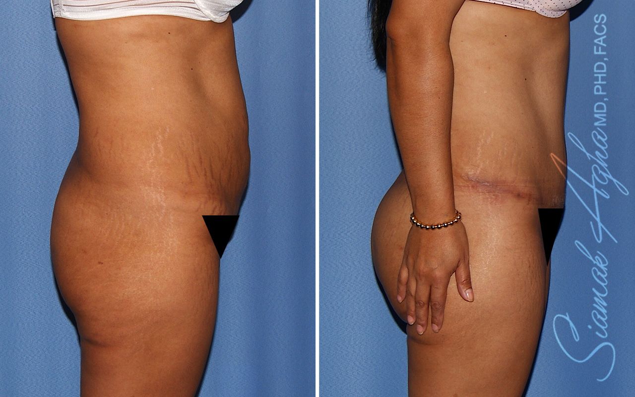 Tummy Tuck Before & After