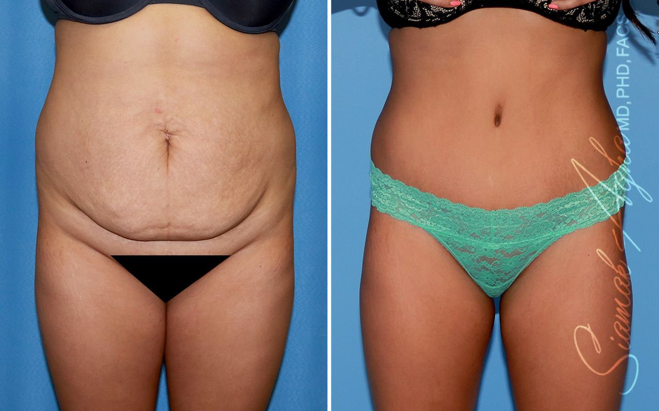 Tummy Tuck Before & After