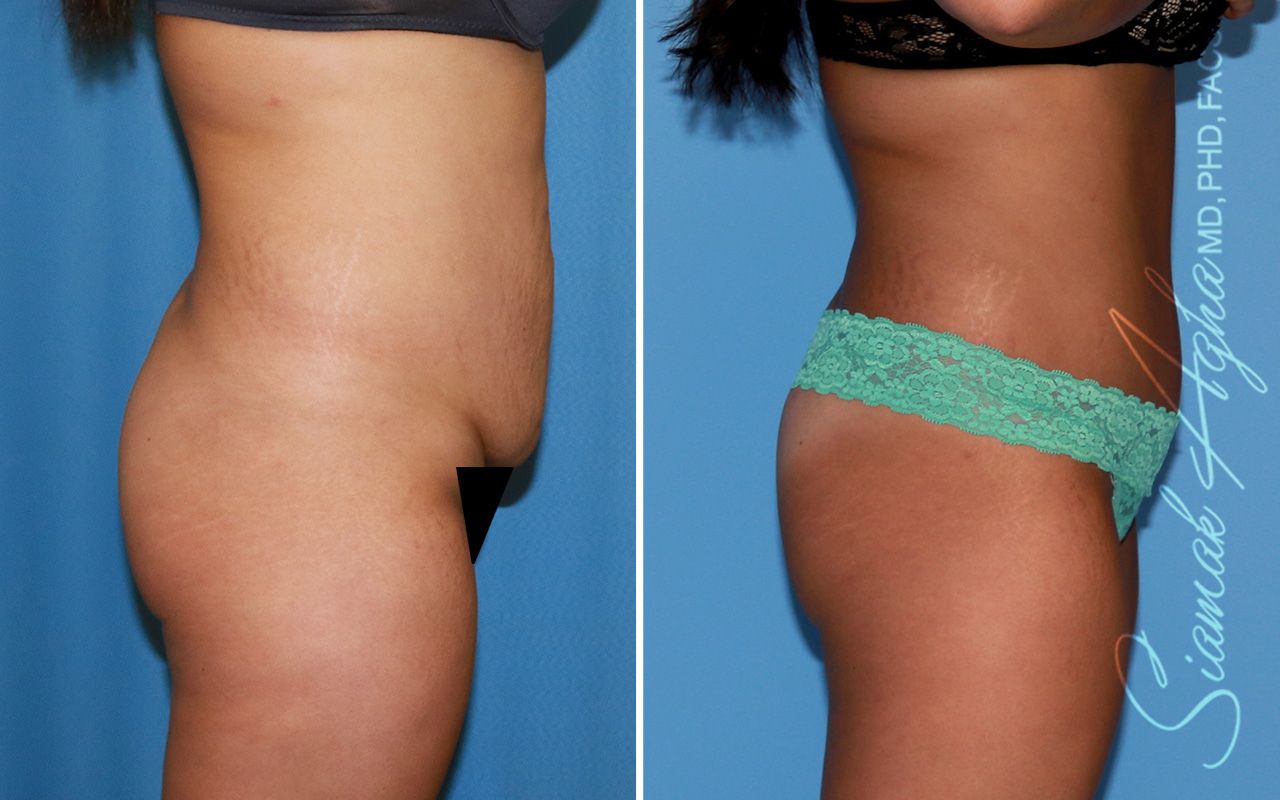 Tummy Tuck Before & After