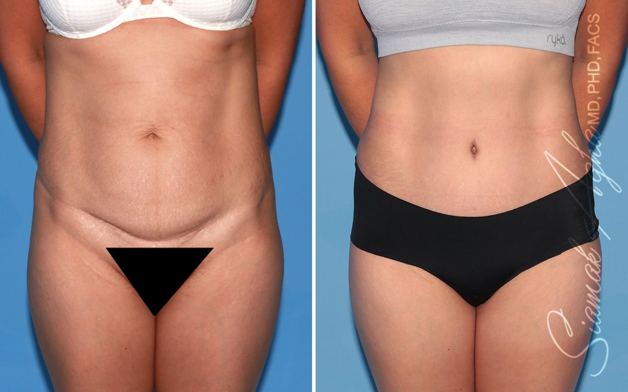 Tummy Tuck Before & After