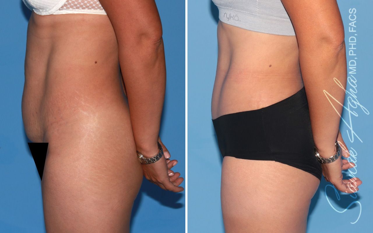 Tummy Tuck Before & After