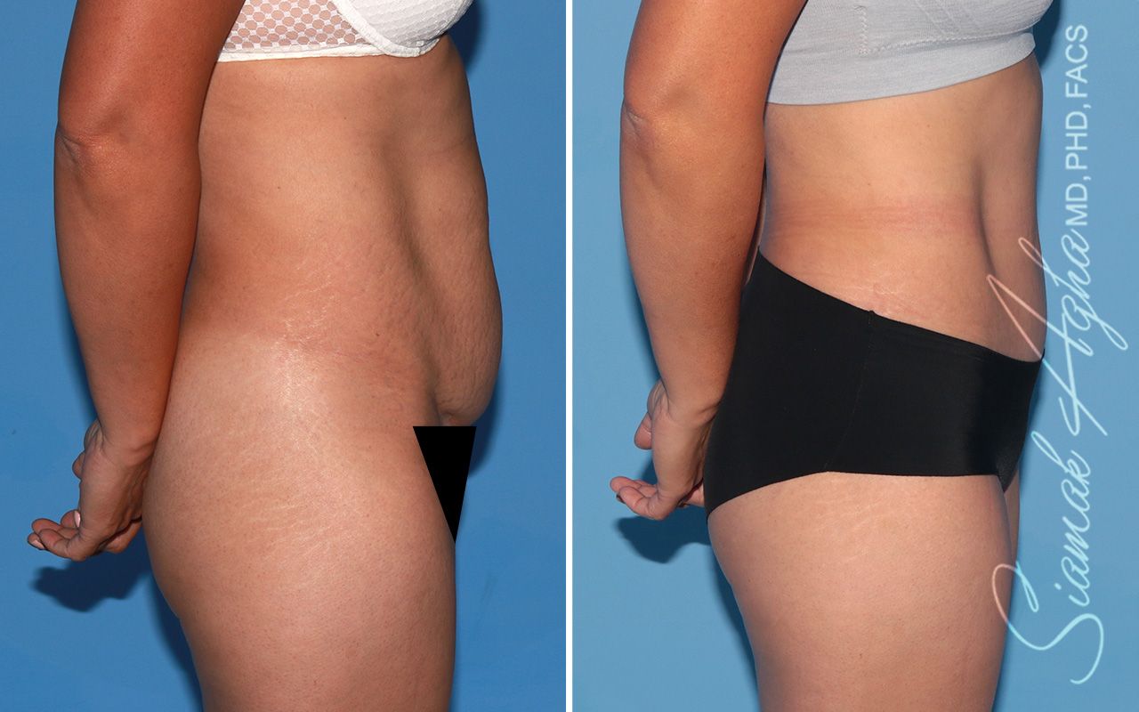 Tummy Tuck Before & After