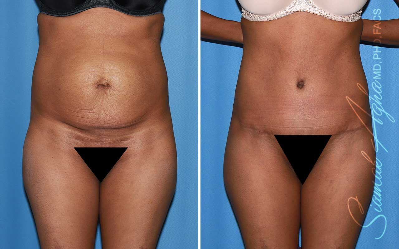 Tummy Tuck Before & After