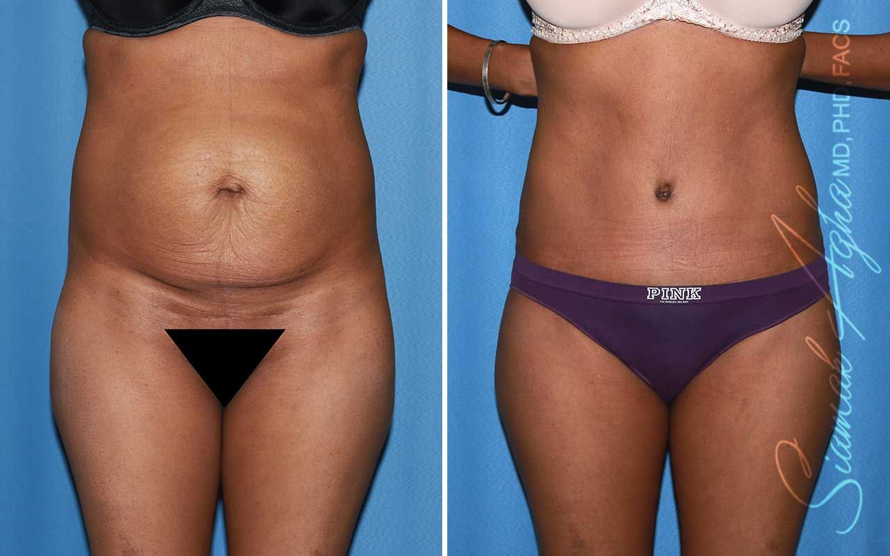 Tummy Tuck Before & After