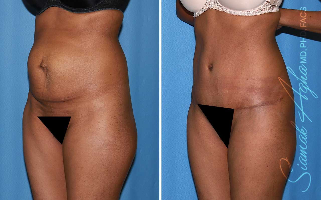 Tummy Tuck Before & After