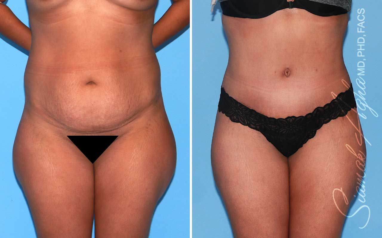 Tummy Tuck Before & After
