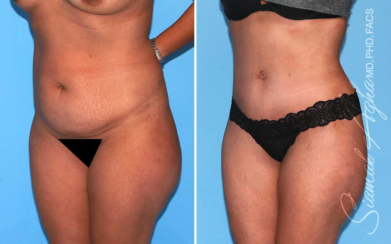 Tummy Tuck Before & After