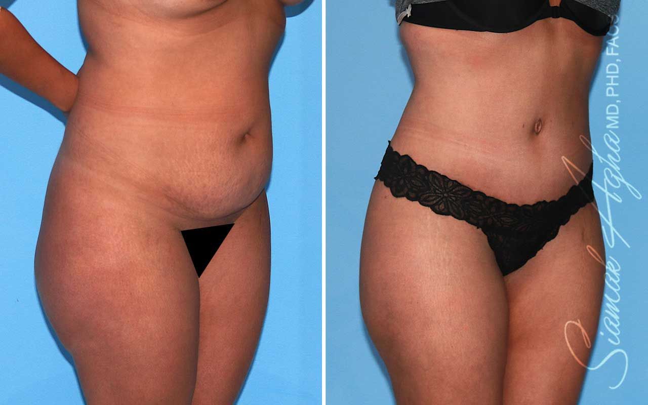 Tummy Tuck Before & After