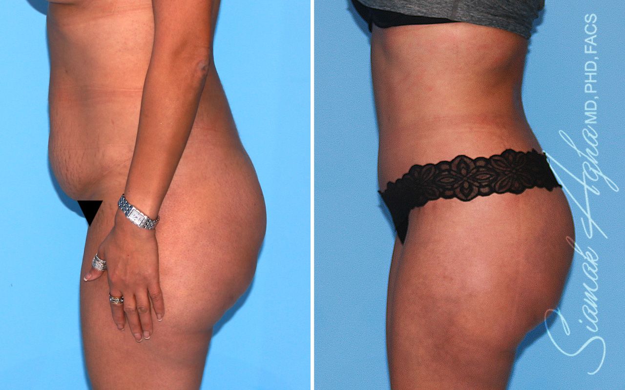 Tummy Tuck Before & After
