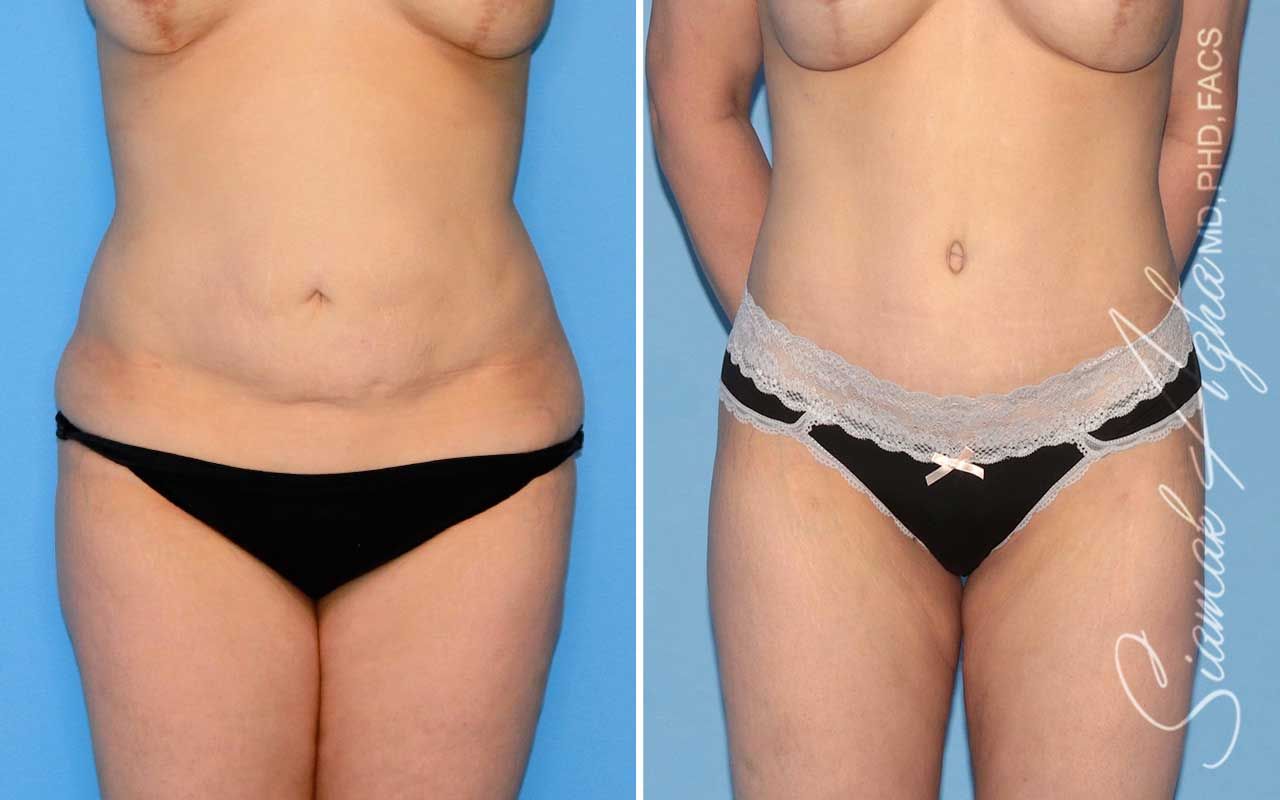 Tummy Tuck Before & After