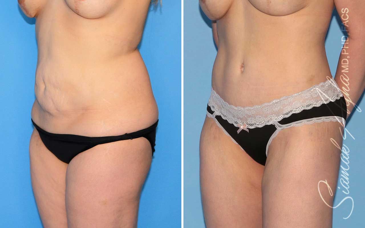 Tummy Tuck Before & After