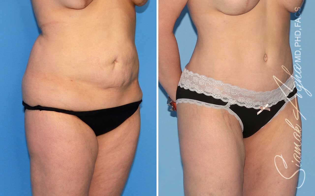 Tummy Tuck Before & After