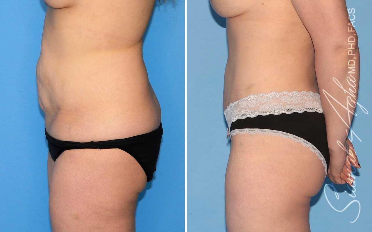Tummy Tuck Before & After