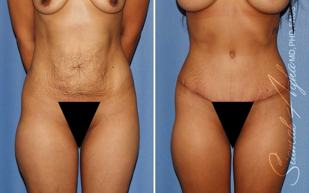 Tummy Tuck Before & After