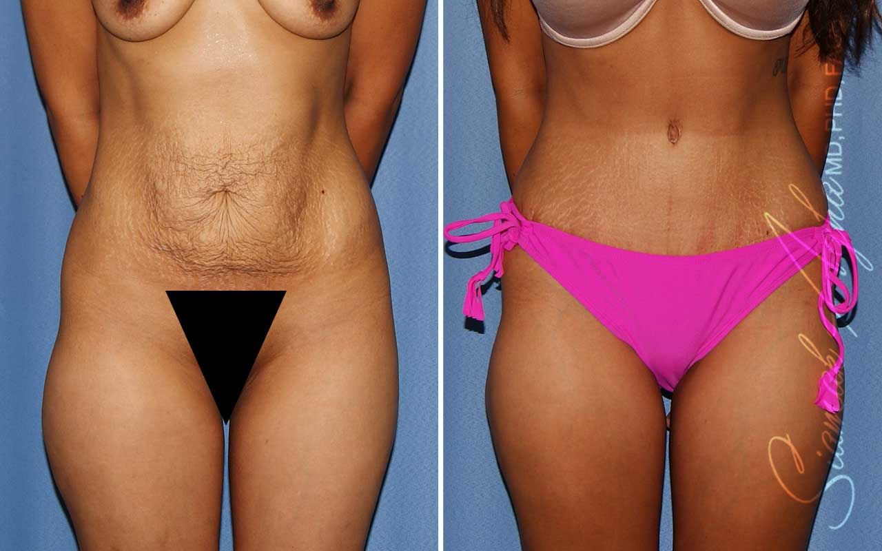 Tummy Tuck Before & After