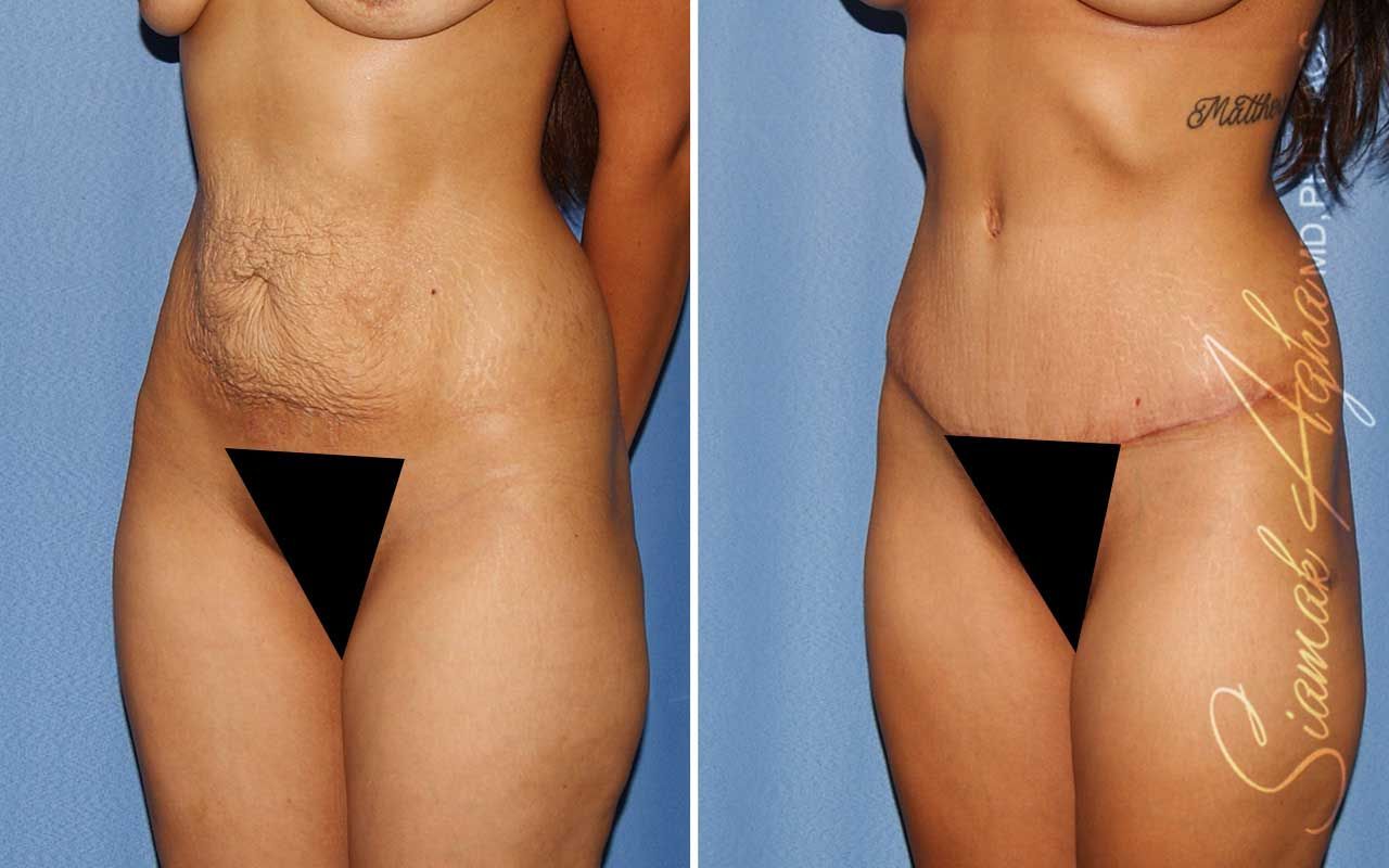 Tummy Tuck Before & After