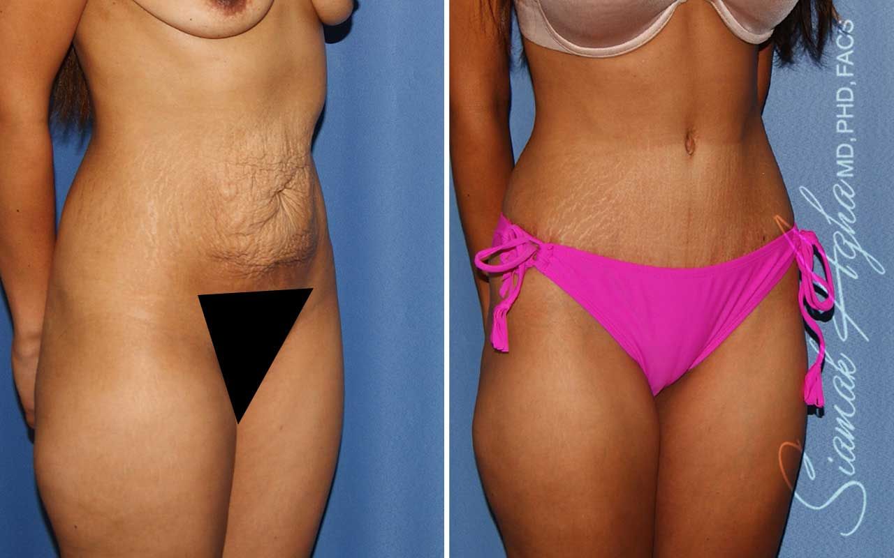 Tummy Tuck Before & After