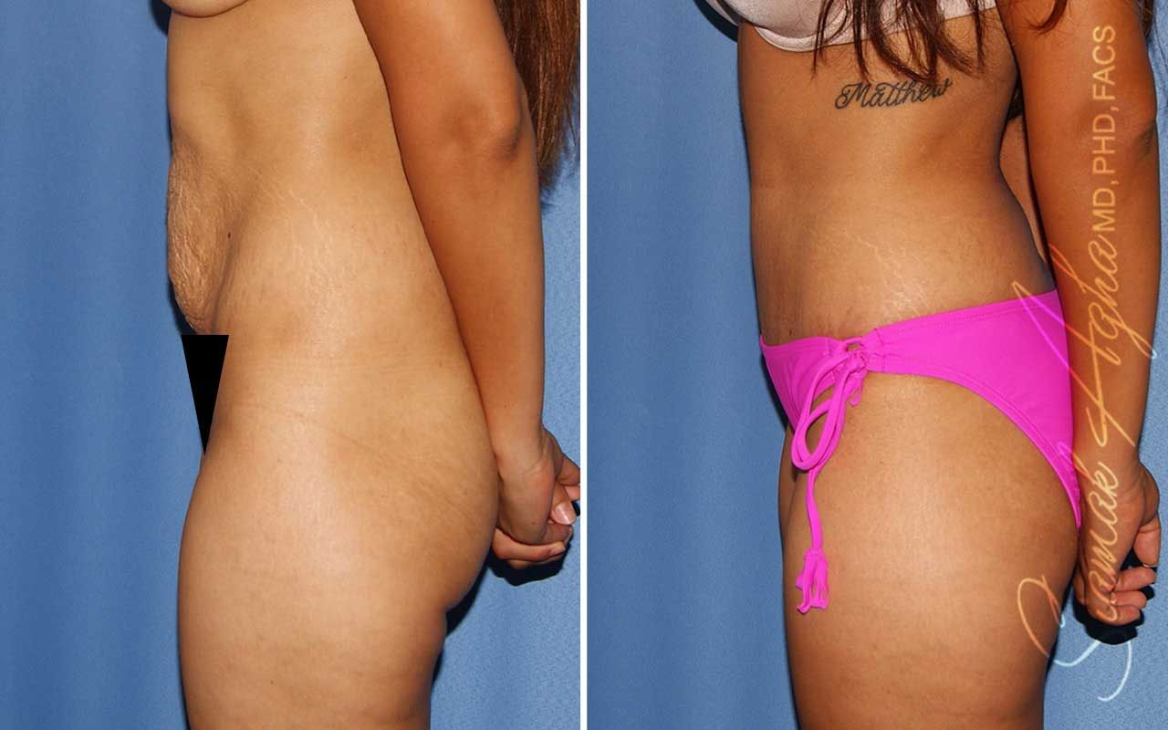 Tummy Tuck Before & After