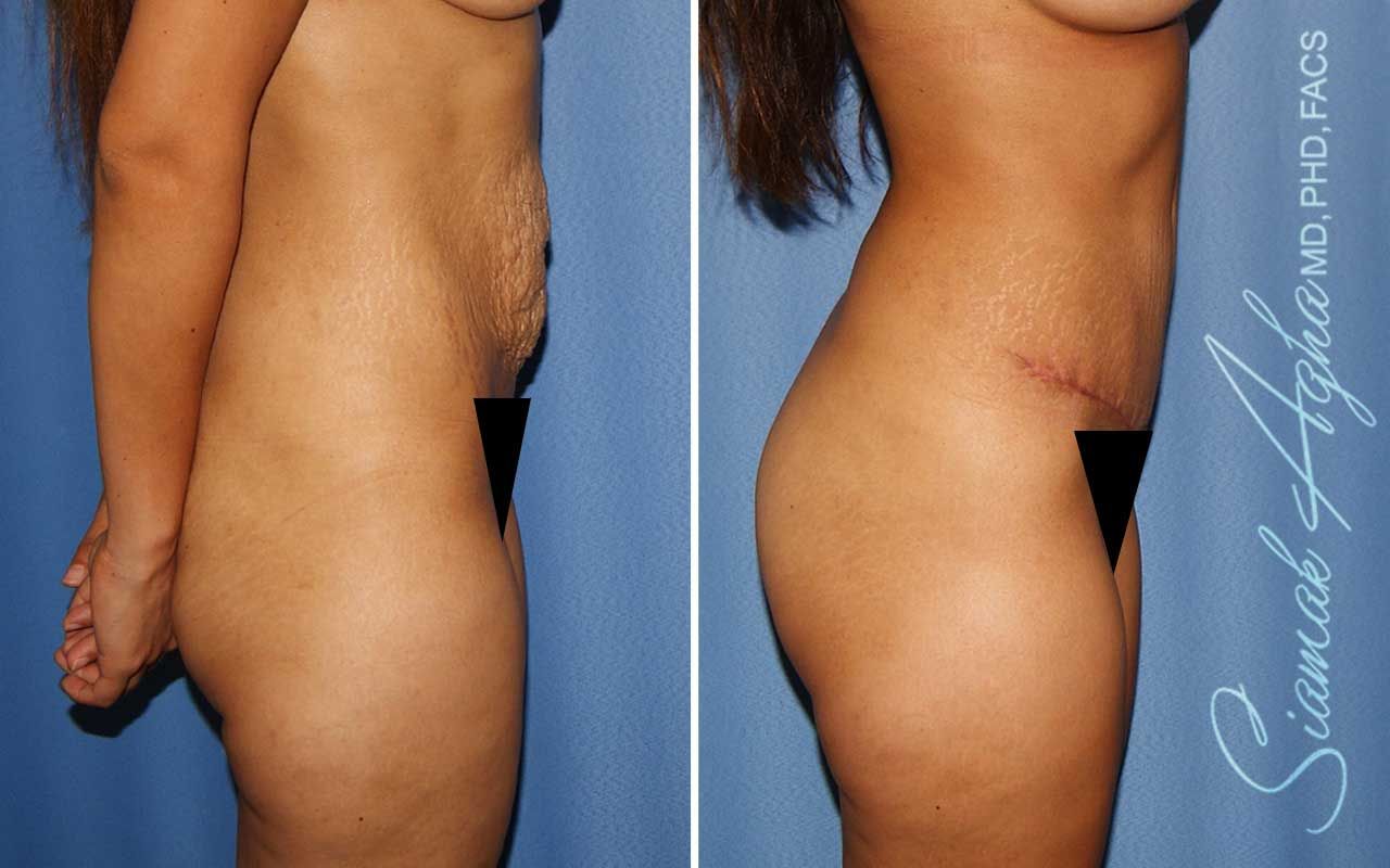 Tummy Tuck Before & After