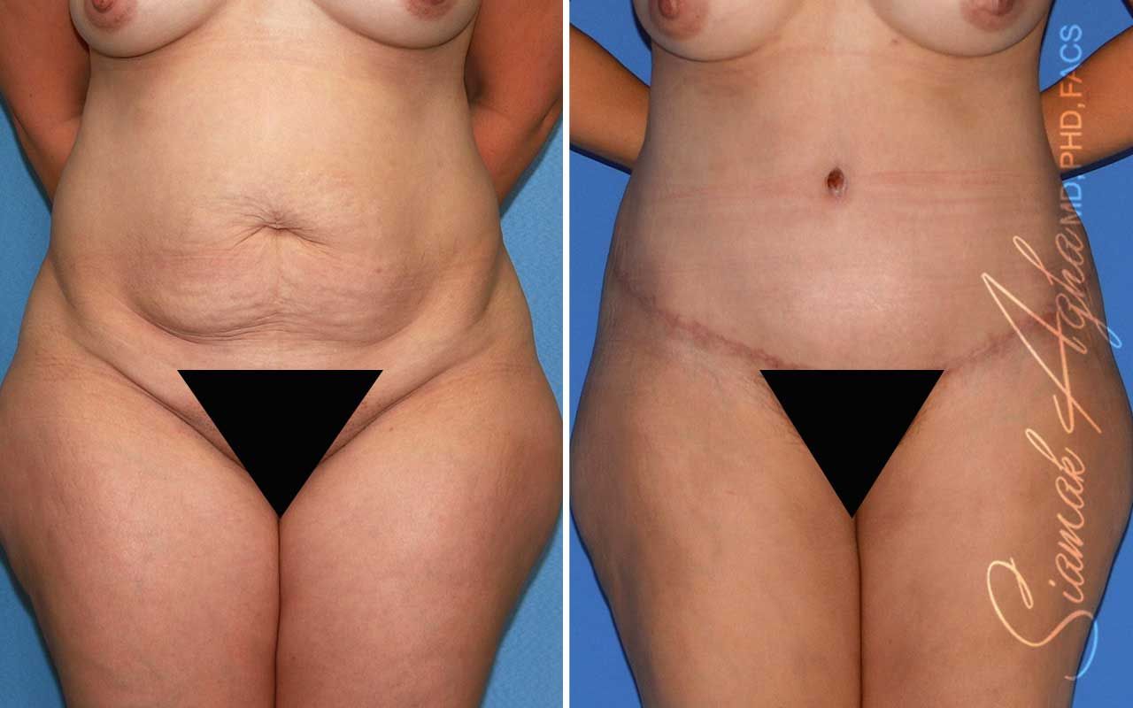 Tummy Tuck Before & After