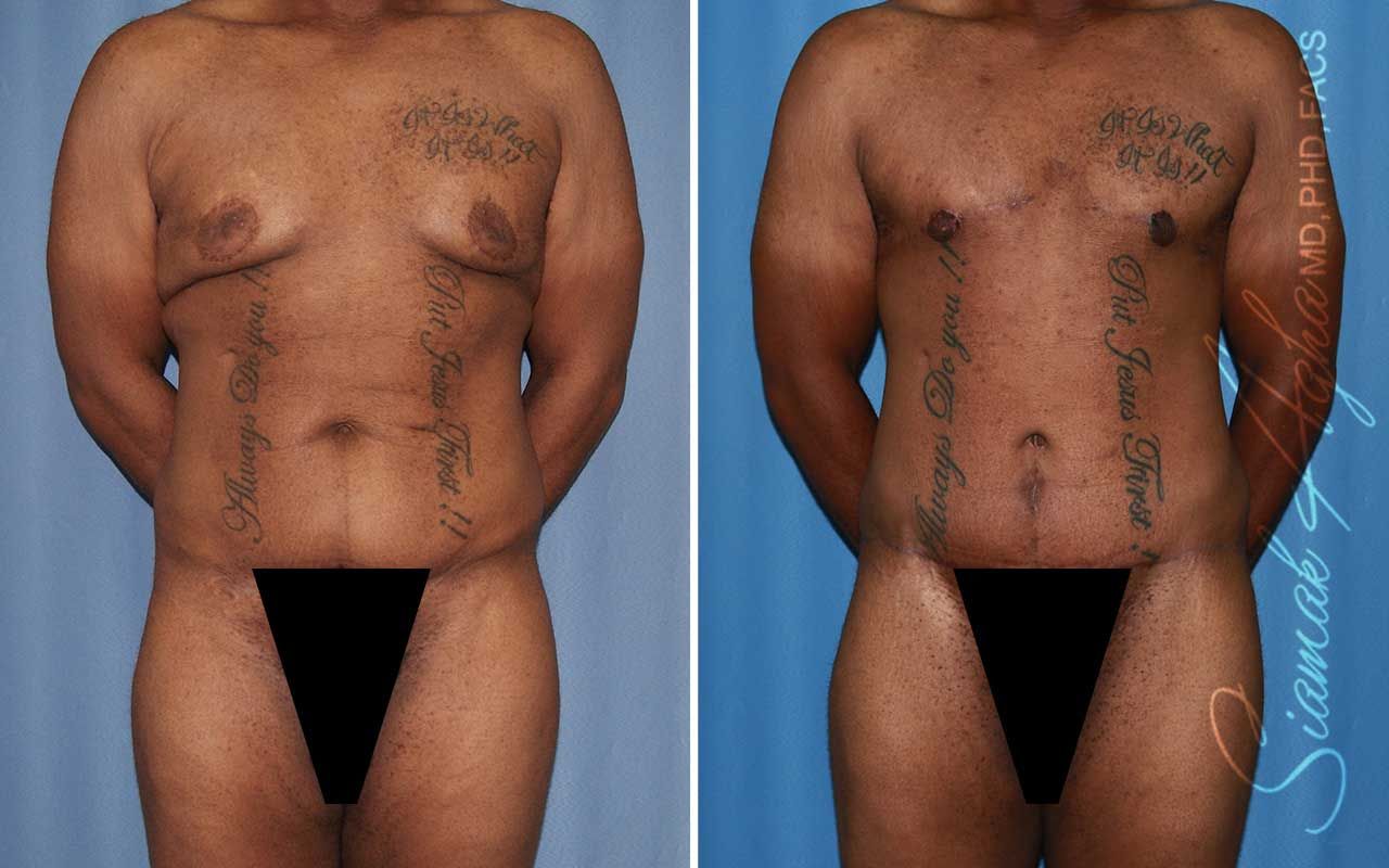Tummy Tuck Before & After