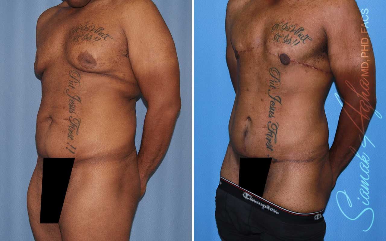 Tummy Tuck Before & After
