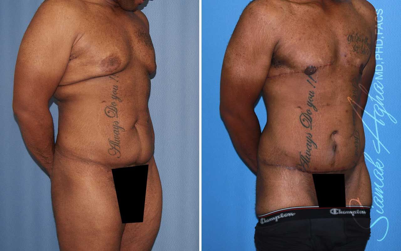 Tummy Tuck Before & After
