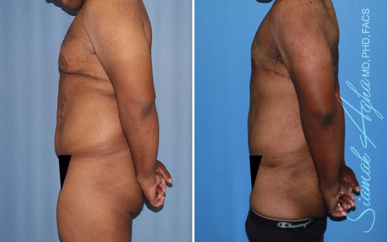 Tummy Tuck Before & After