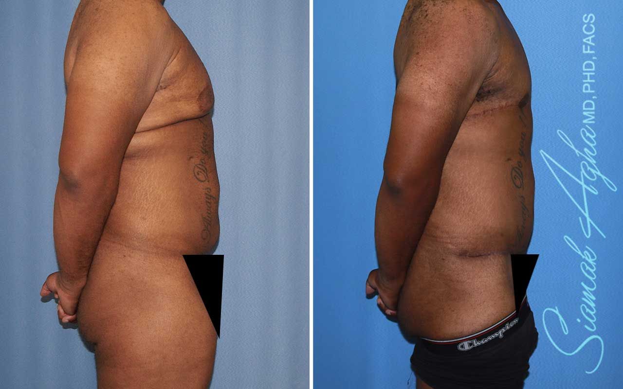 Tummy Tuck Before & After