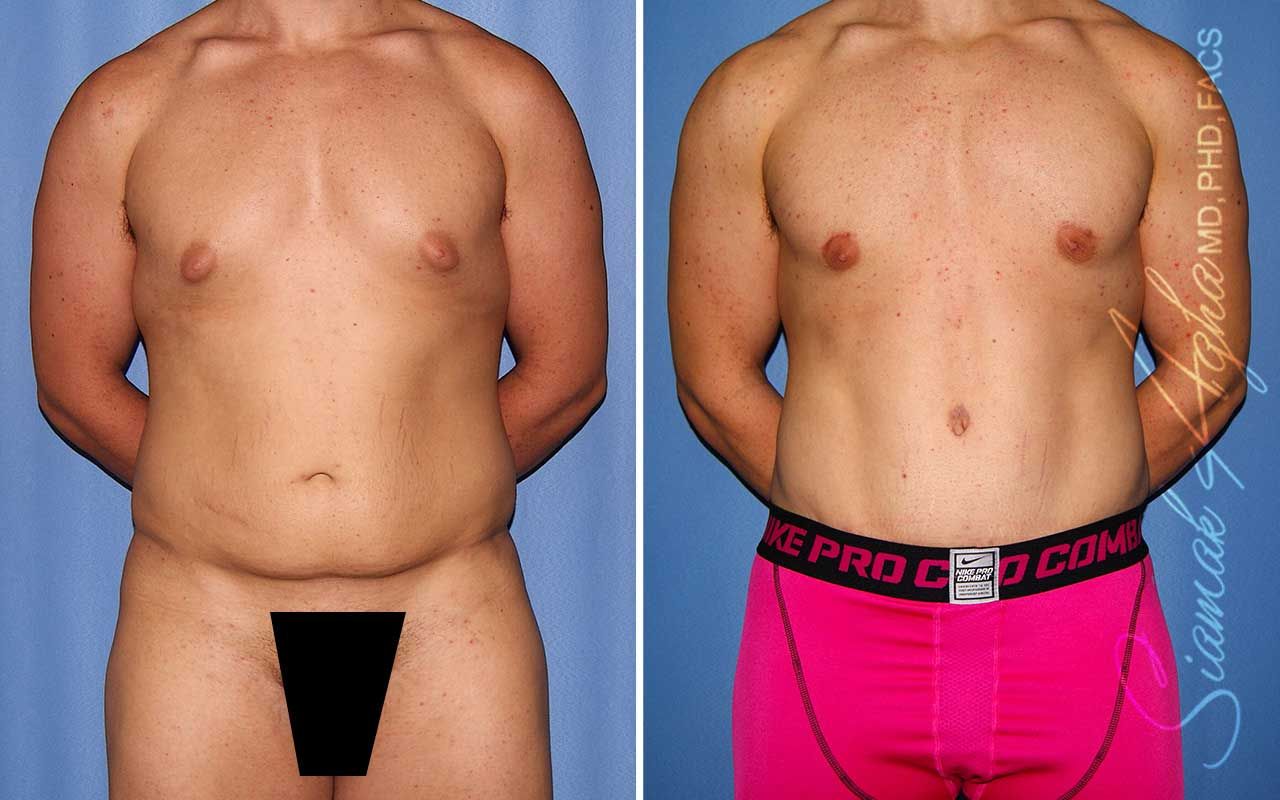 Tummy Tuck Before & After