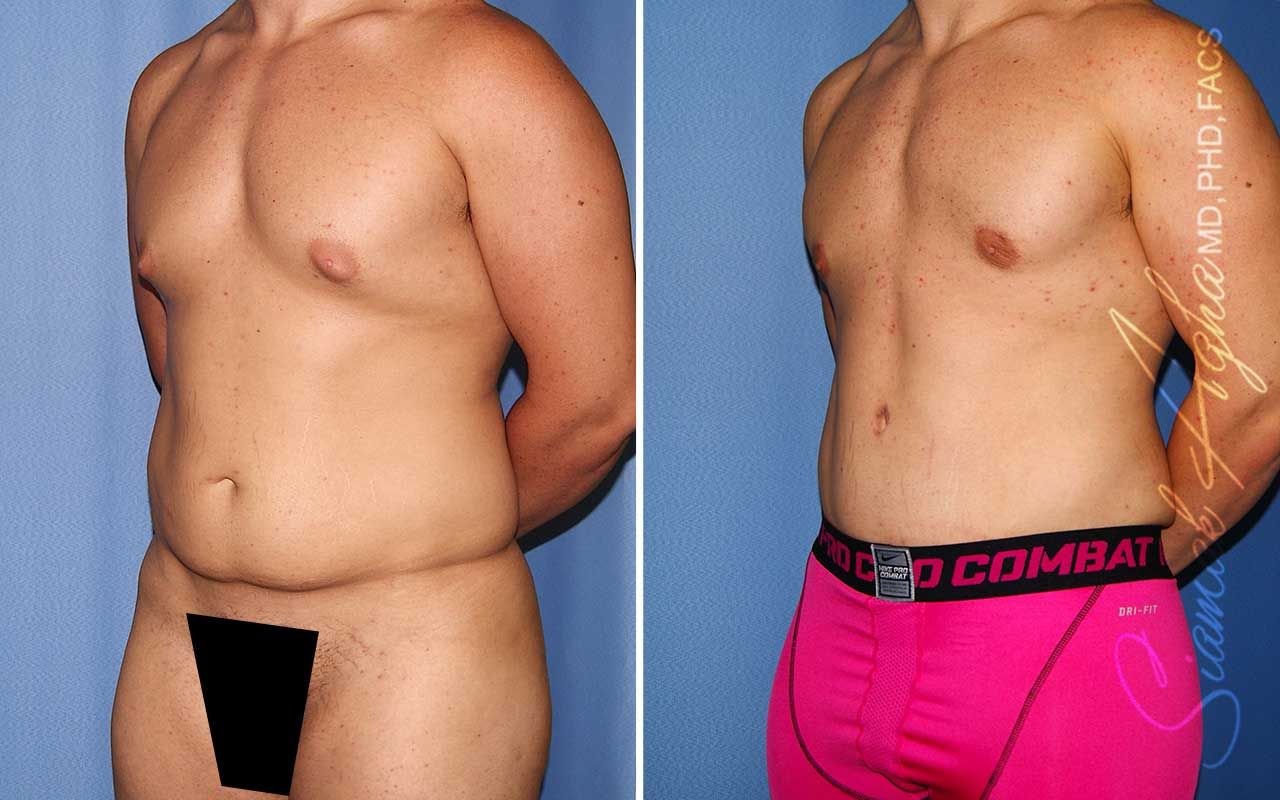Tummy Tuck Before & After