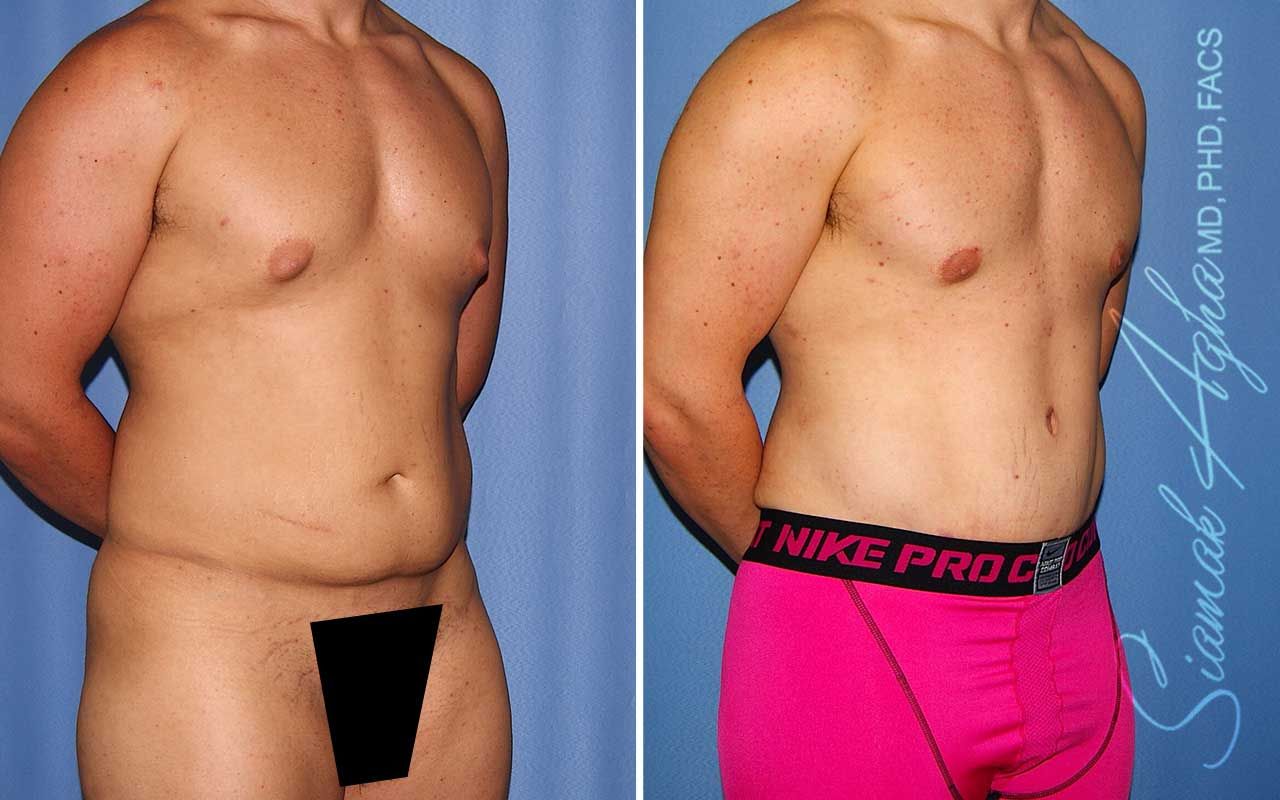 Tummy Tuck Before & After