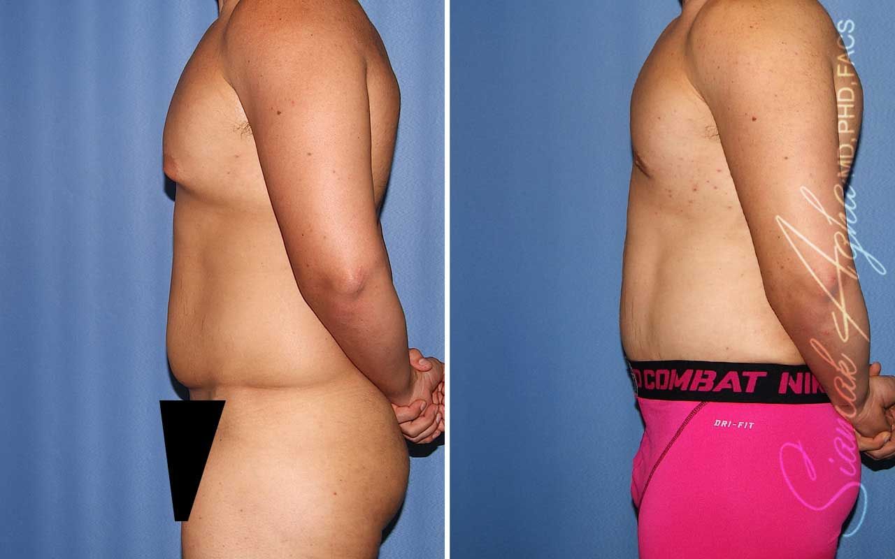Tummy Tuck Before & After